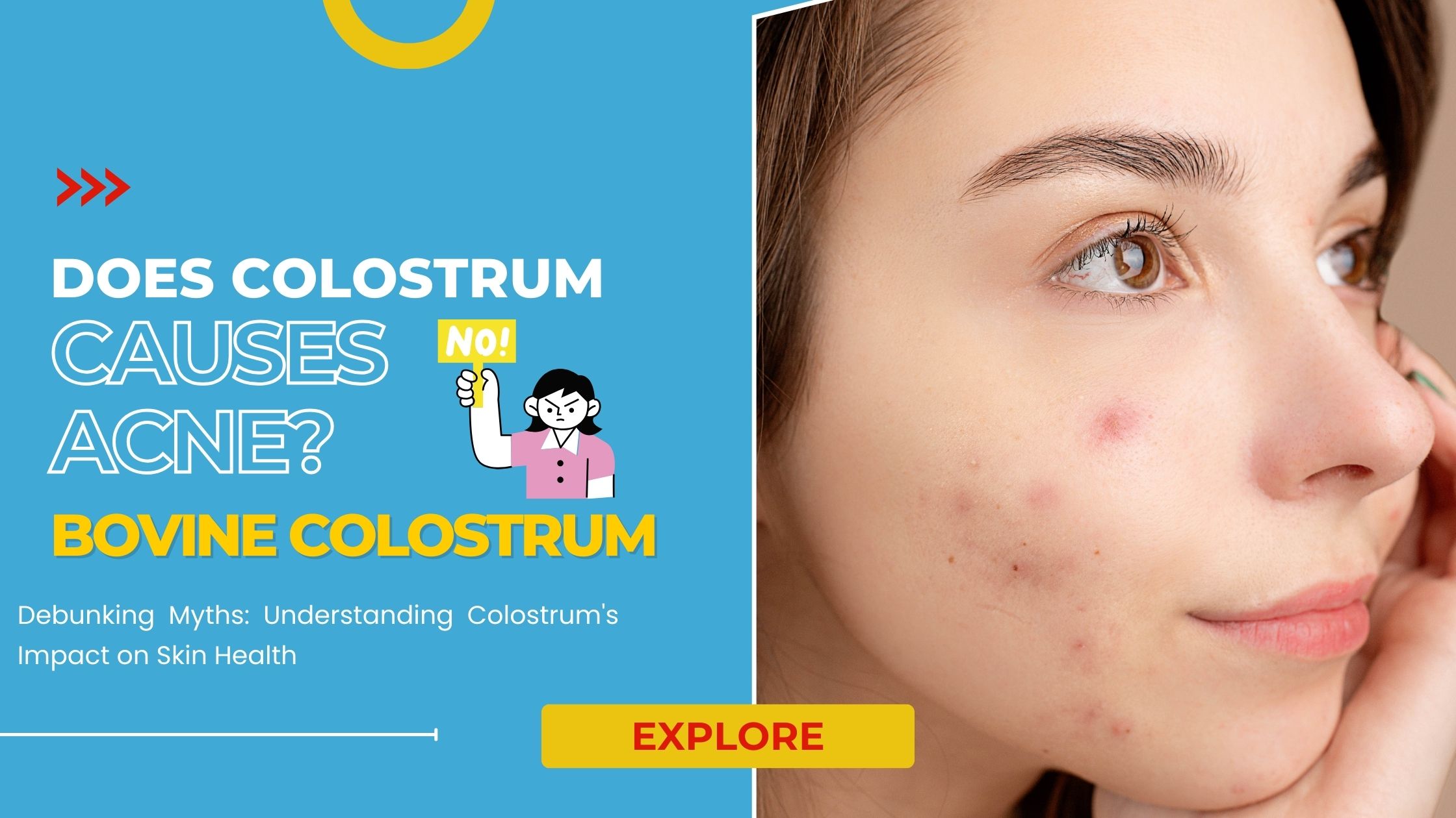 Colostrum Cause Acne